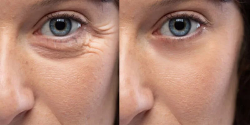 remove wrinkling on skin 